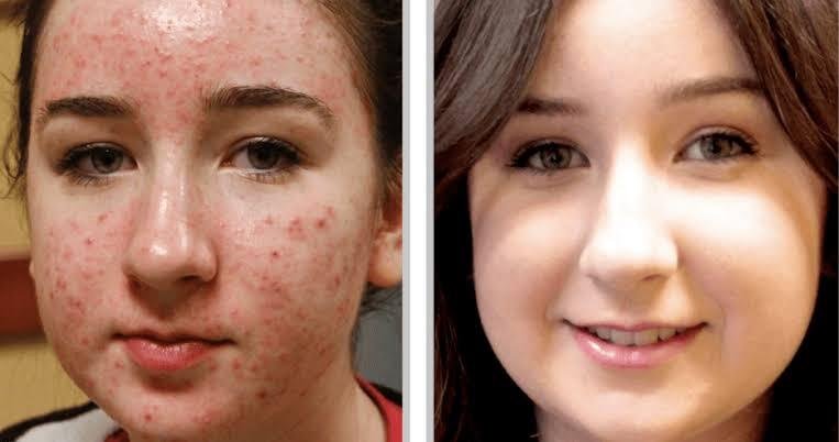Acne Facial in Perth